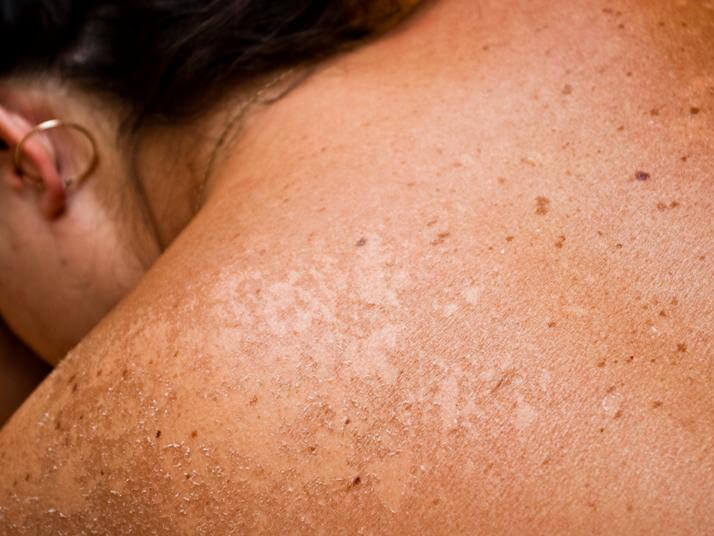 Symptoms-Of-Skin-Cancer